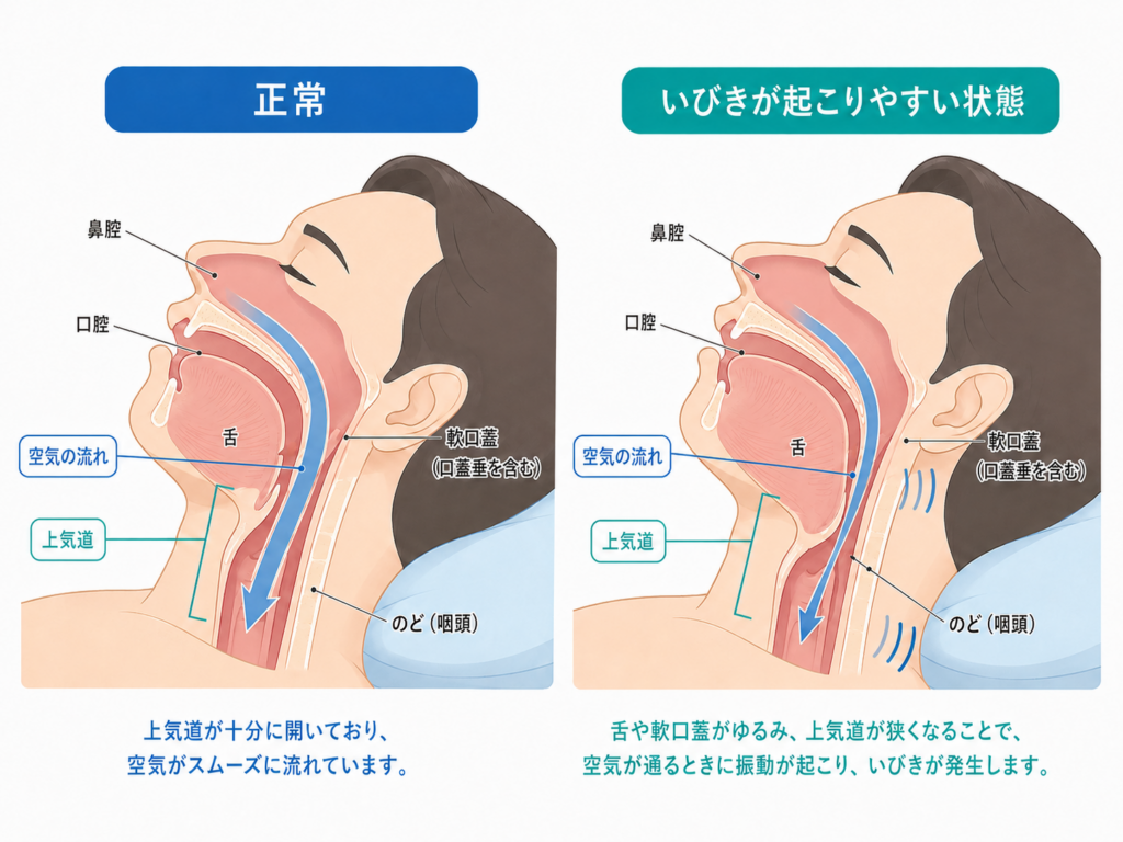 正常に開いた上気道と、舌や軟口蓋によって狭くなり、いびきが起こりやすい上気道の比較イラスト